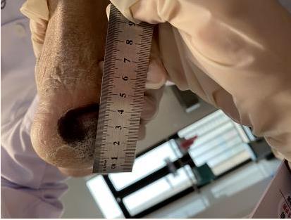 老虎机app
（自治区人民医院东院）开展首次护理远程会诊