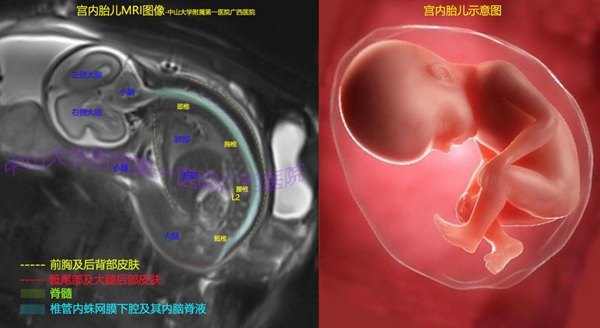 我院首例胎儿磁共振技术检查成功完成