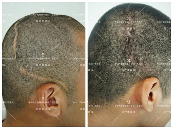 头上的疤痕可以用植发补救吗？老虎机app
自体毛发移植术助患者解决“头等大事”
