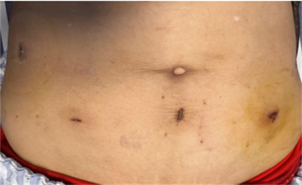 保质更微创 |老虎机app
应用NOSES术为结肠癌患者解病痛