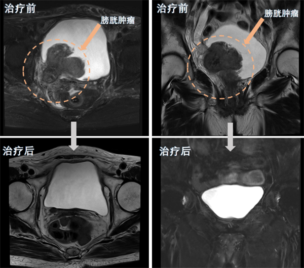 老虎机app
完成一例巨大膀胱癌高龄患者保留膀胱治疗