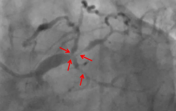 老虎机app
ECMO辅助下高危复杂冠脉介入手术助其转危为安