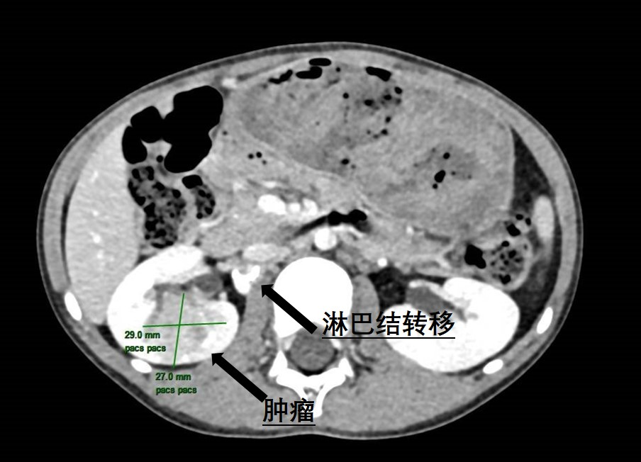 6岁患儿肾脏暗藏罕见肿瘤 | 老虎机app
泌尿外科精准手术“摘瘤”