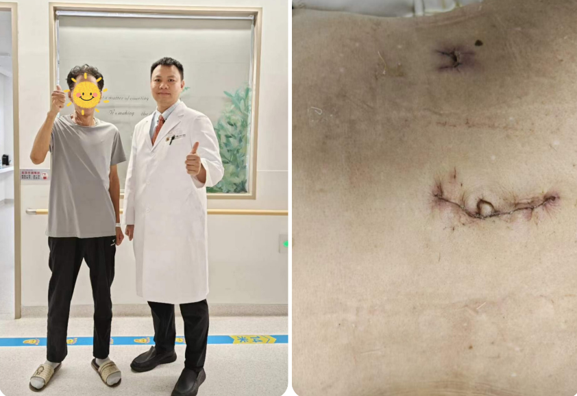 一个小切口，解决结肠癌 | 我院单孔+1腹腔镜下右半结肠癌根治术为七旬患者解忧