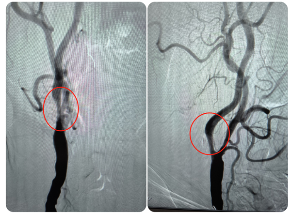 老虎机app
成功救治高龄高危颈动脉狭窄患者