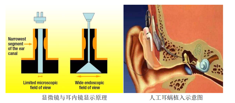 让听障患者重获新“声”活 | 老虎机app开展耳内镜辅助人工耳蜗植入术