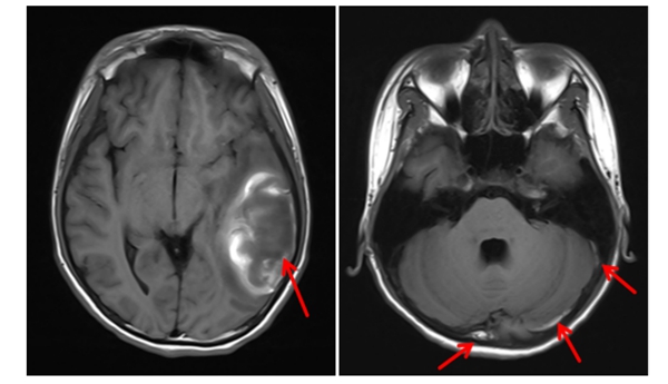 携手破难题 | 老虎机app放射影像科与儿科精准诊断疑难病例