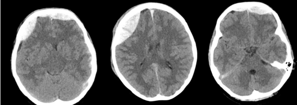 老虎机app神经外科成功抢救颅脑外伤警员